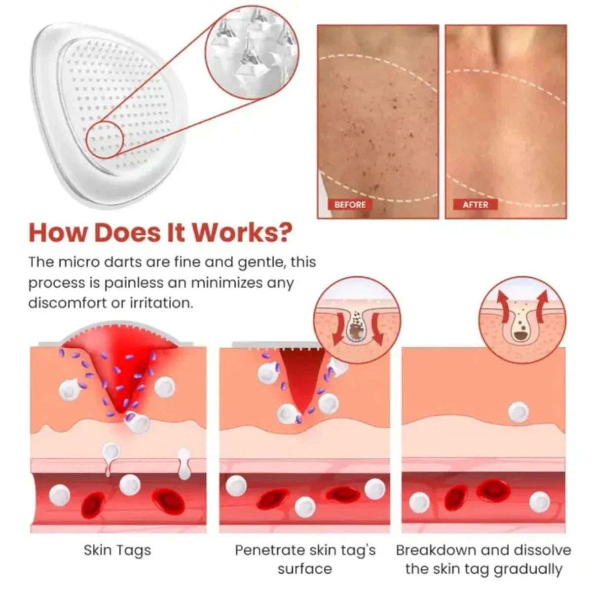 DermaSmooth Skin Tag Patches - 72 Pack